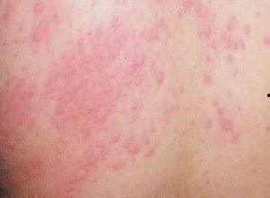 湿疹可以吃毛瓜吗,湿疹患者适宜食用毛瓜的探讨