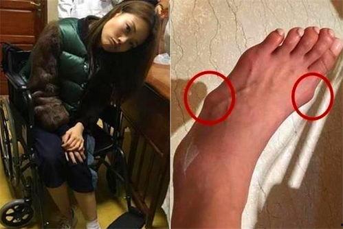 女明星扭伤脚