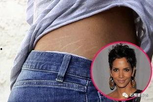 明星去除妊娠纹